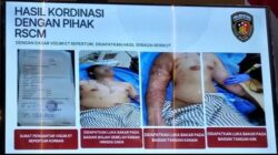 RSCM Pastikan Kondisi Aktivis KontraS Andrie Yunus Korban Penyiraman Air Keras Sudah Stabil